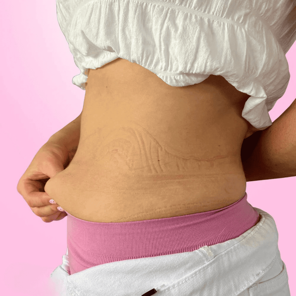 SnowBloom™ Tummy Lifting Tapes ( 10 Tapes )