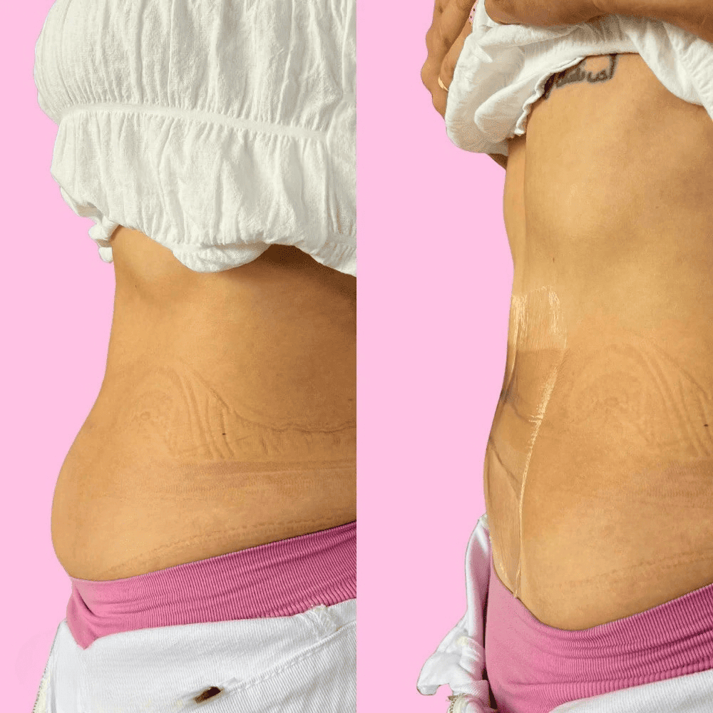 SnowBloom™  Tummy Lifting Tapes ( 10 Tapes )